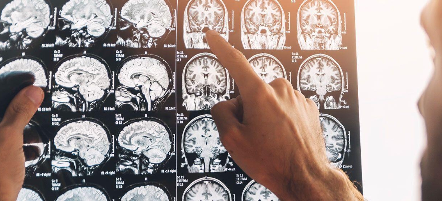 МРТ головного мозга + ангиография (без контрастного усиления) 