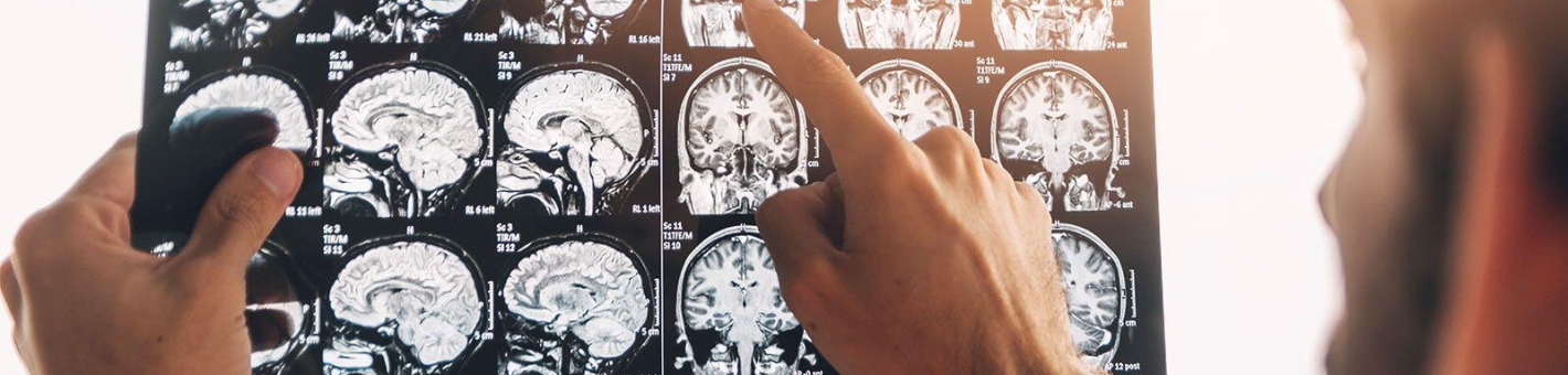 МРТ головного мозга (без контрастного усиления) 