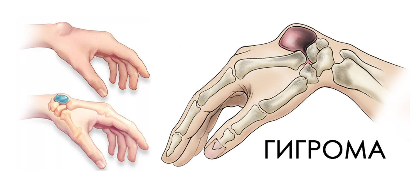 Удаление гигромы