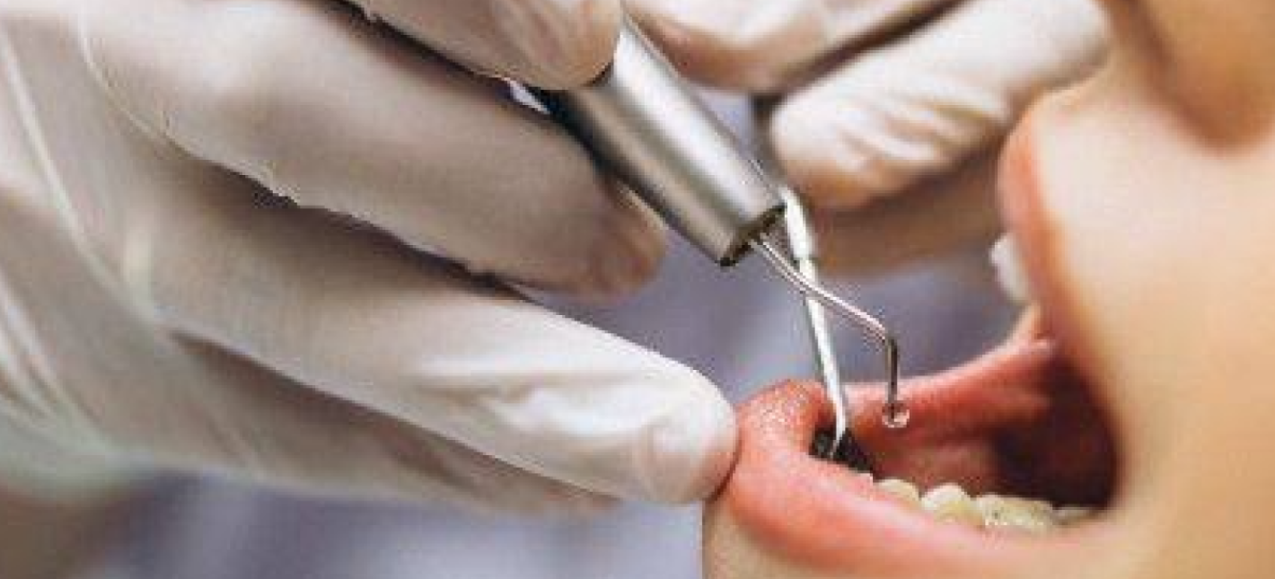 Реставрация коронковой части одного зуба пломбировочным материалом